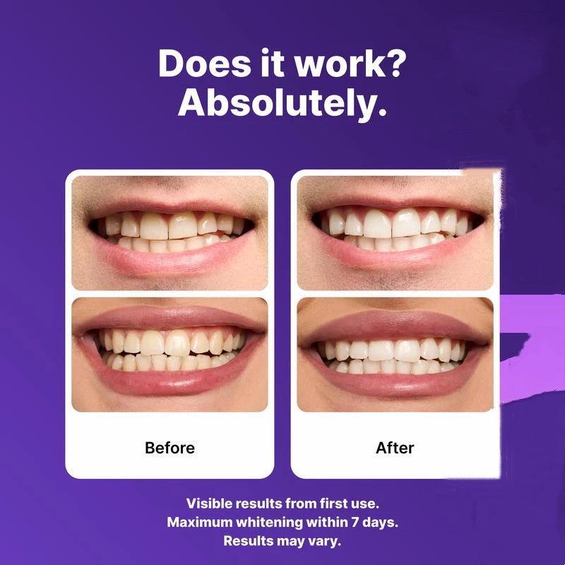 Teeth Whitening Strips - Pack of 14